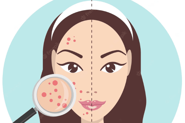 Topical Clindamycin: A Guide for Acne Treatment