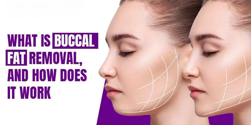 Everything You Need to Know About Buccal Fat Removal