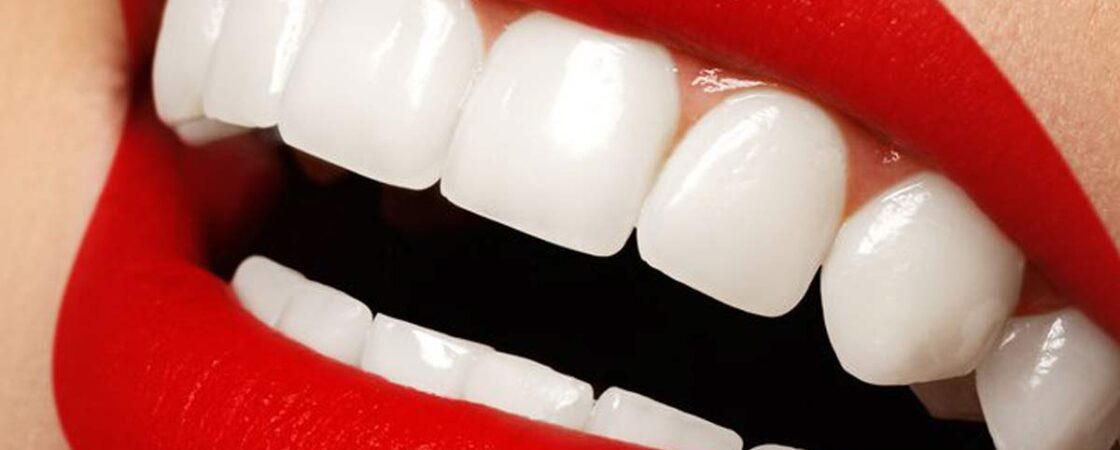 Top-Rated Dental Veneers Clinic in Dubai