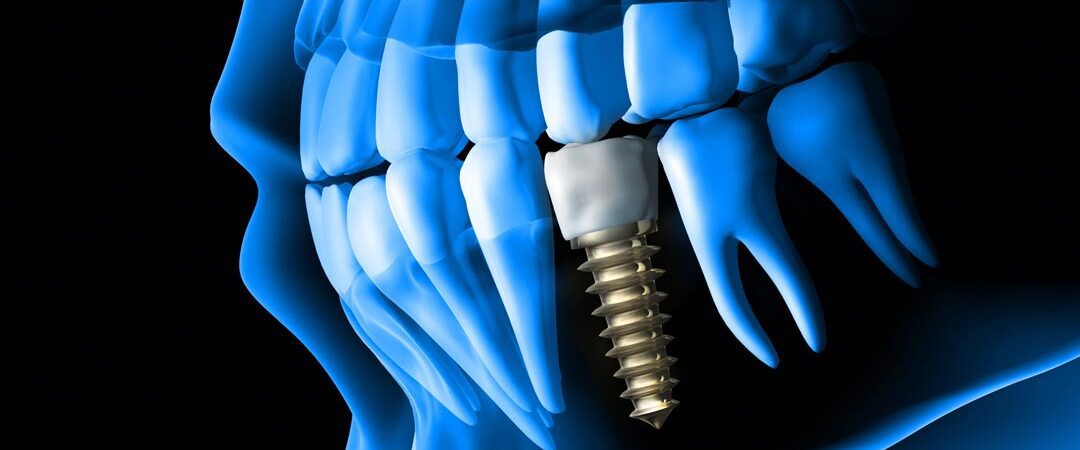 Best Dental Implant Specialist Near You