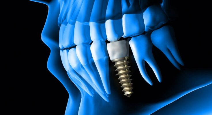 Best Dental Implant Specialist Near You