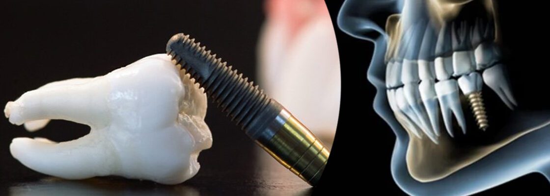 Dental Implant in Dubai