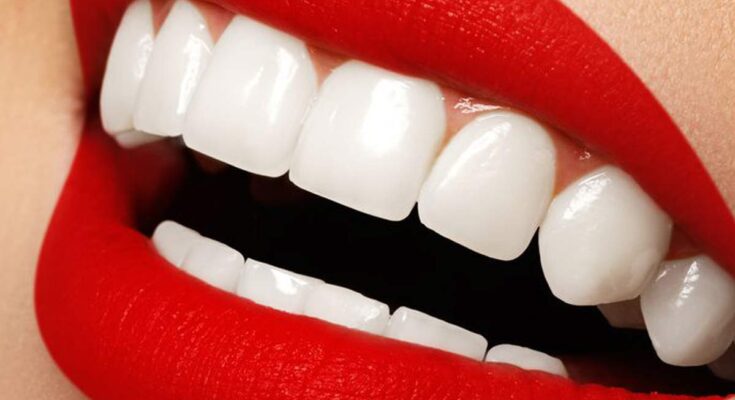 Best Dental Veneers Treatment in Dubai,