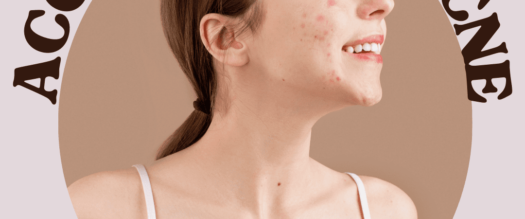 accutane for acne