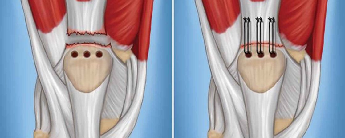 quadriceps-tendonitis