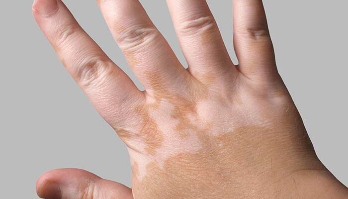 cure for vitiligo in australia