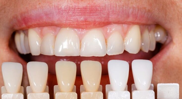 professional teeth whitening before and after
